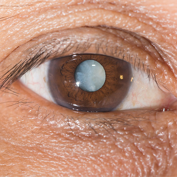 Panamá Retina Clinic - Servicio - Catarata